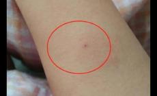 正常的結(jié)核皮試是什么樣的?正常人的結(jié)核皮試圖