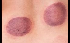 拔罐濕氣重是什么顏色 拔罐后濕氣重圖片