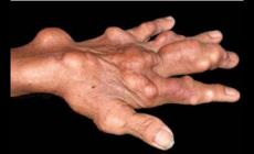 尿酸高有哪些癥狀有哪些？尿酸高有哪些癥狀介紹