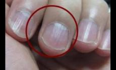 指甲有豎紋是身體的什么信號(hào)啊