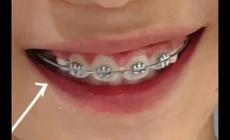 矯正牙齒可以報銷醫保嗎兒童（矯正牙齒可以報銷醫保嗎）