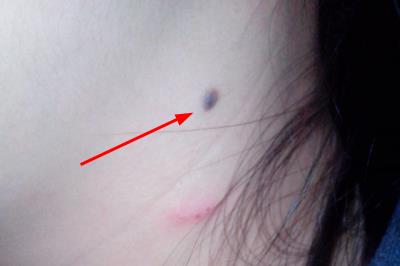 醫(yī)院祛痣掛什么科室 醫(yī)院祛痣掛什么科室的號